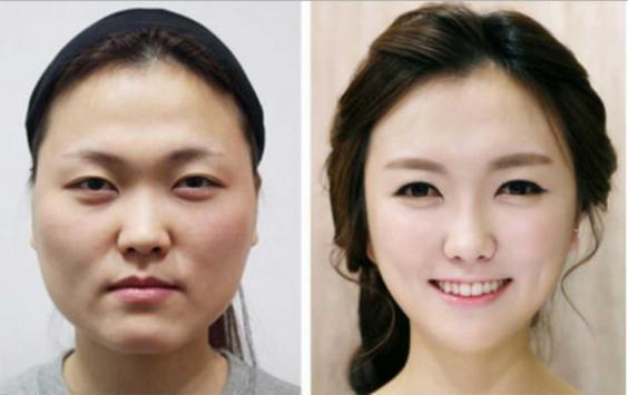 cosmetic-surgery-trends-face[1]